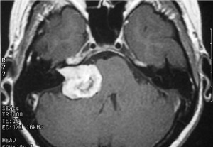 Acoustic Neuroma Brain Cancer