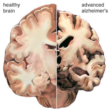 healthy-vs-advanced-alzheimer-brain