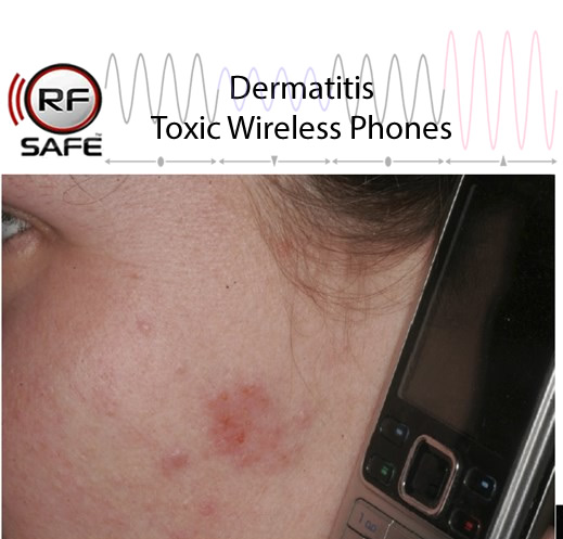 Dermatitis-Toxic-Cell-Phone