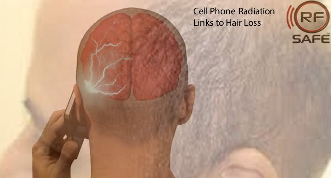 hair-loss--Cell-Phone-Radiation